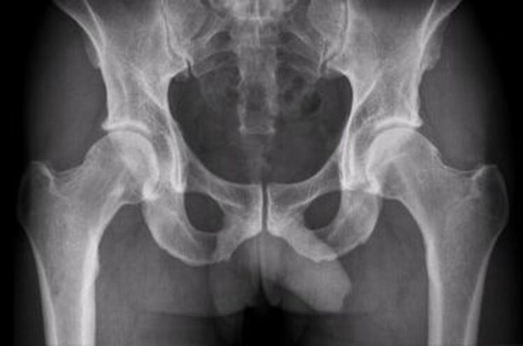 x-ray tina gabungan hip pikeun nyeri