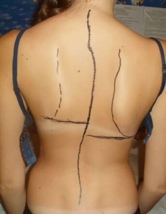 Iga hump