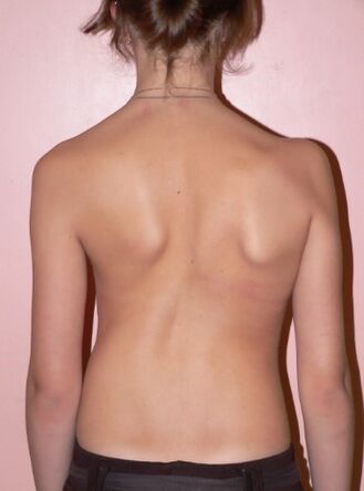 Scoliosis 2 derajat