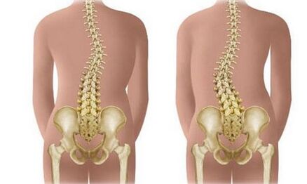 Scoliosis non -Resistant
