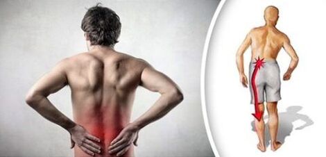Sindrom nyeri sareng osteochrata lumbar radiates ka sukuna
