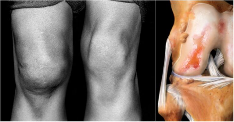 Arthrosis gabungan dengkul sareng nyeri gabungan