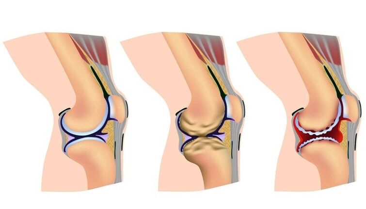Tahap deformasi dina gabungan dengkul pikeun arthrosis