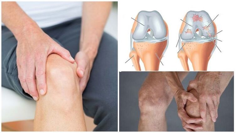 gejala nyeri dengkul arthrosis tina gabungan dengkul