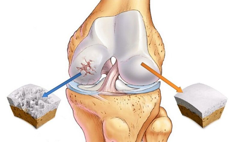 kartilage normal sareng kapangaruhan ku arthrosis