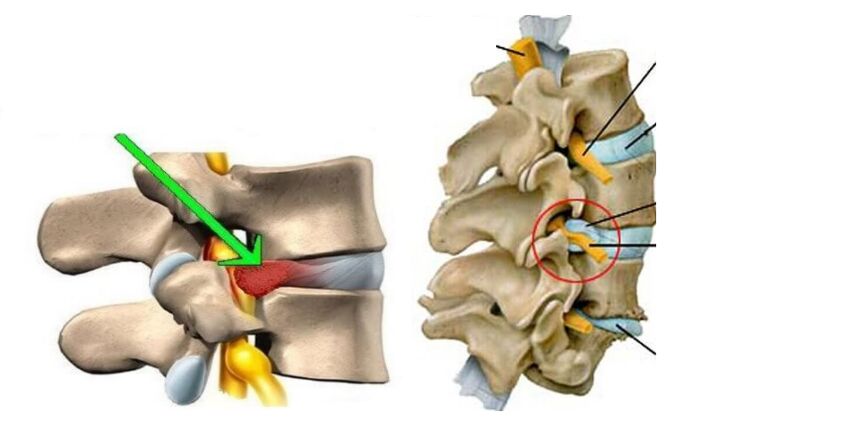 nyeri deui handap kusabab herniation cakram