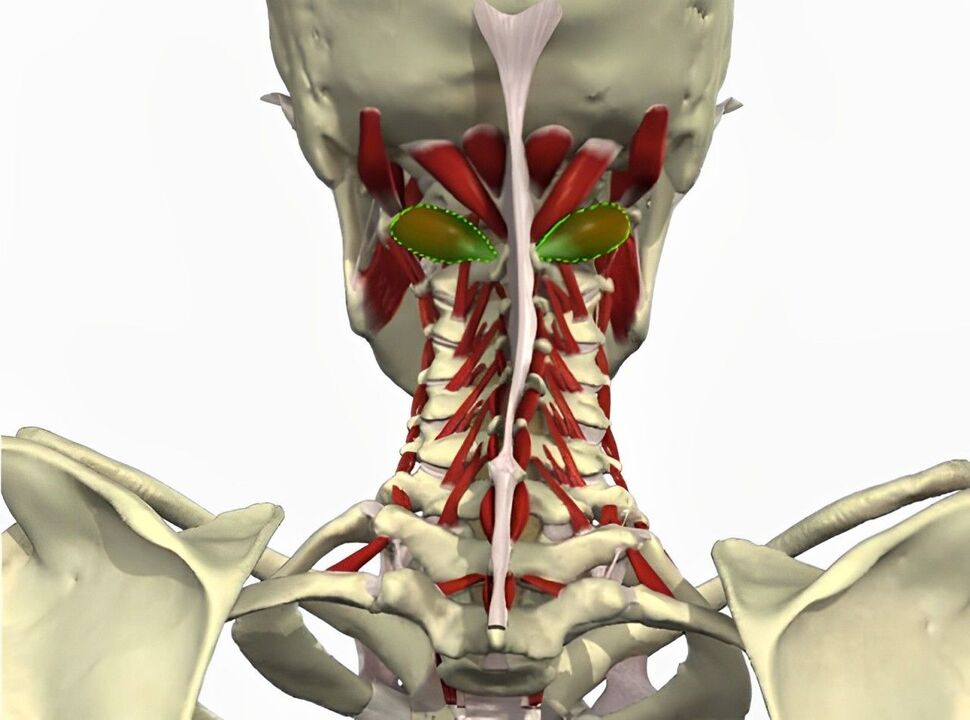 sindrom arteri vertebral