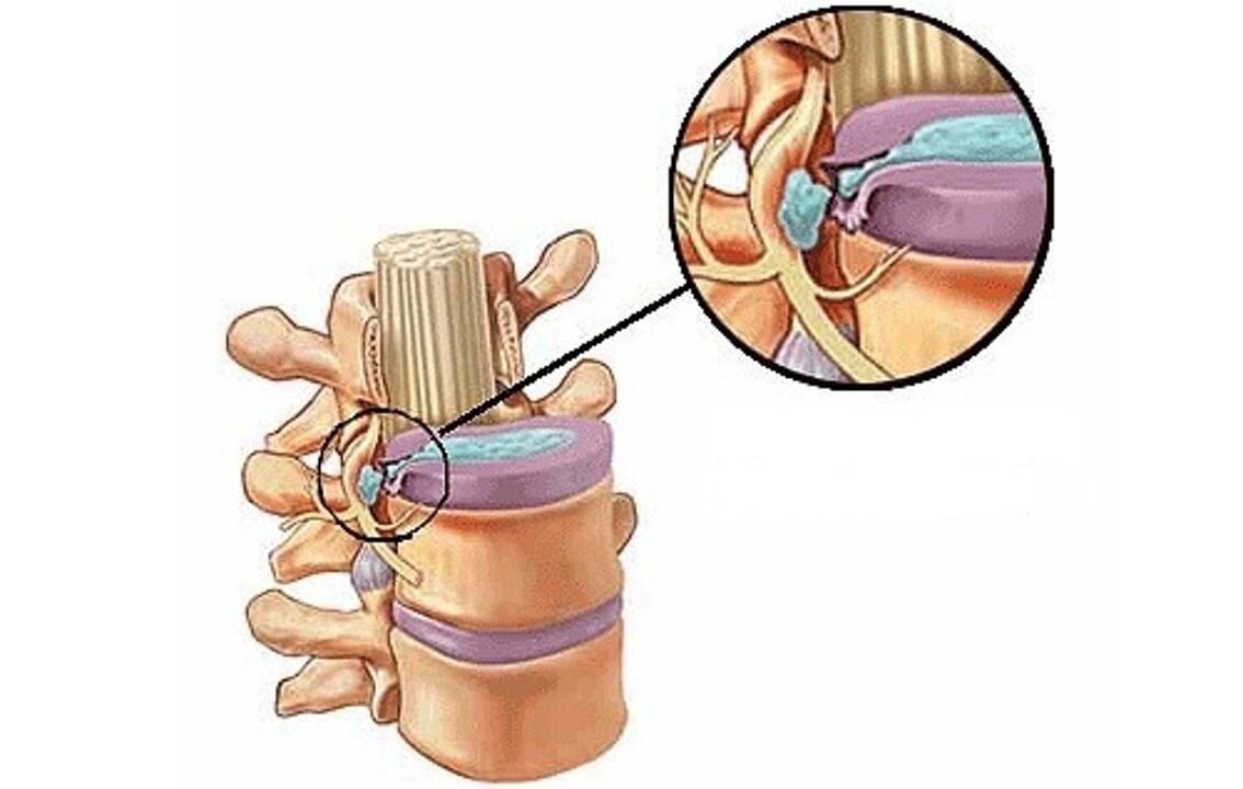 burut intervertebral kalawan osteochondrosis thoracic