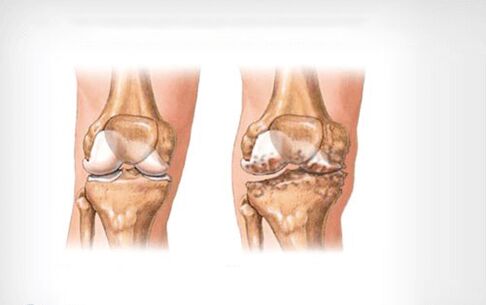 arthrosis tina sendi dengkul