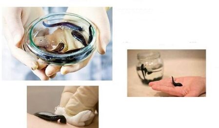 hirudotherapy pikeun arthrosis