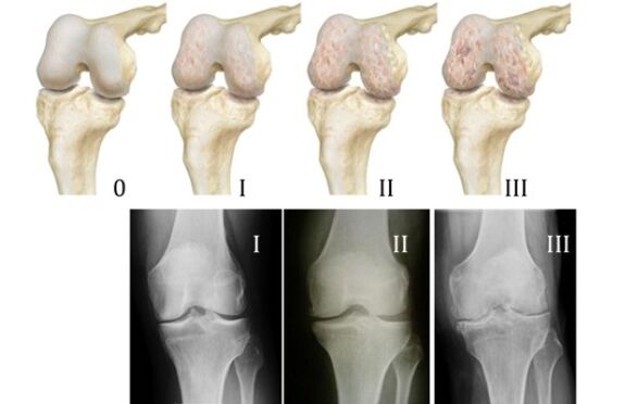 métode pikeun diagnosa arthrosis dengkul