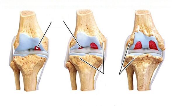 tahapan arthrosis dengkul